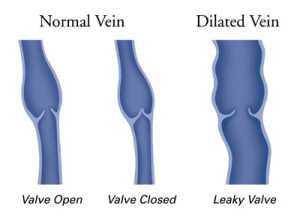 Normal-Vein-vs.-Dilated-Vein