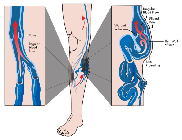 Vein Disorders